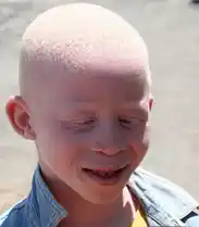 Albinism