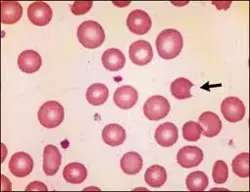 G6PD Deficiency