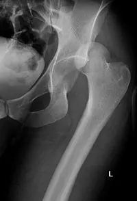 Hip Dislocation