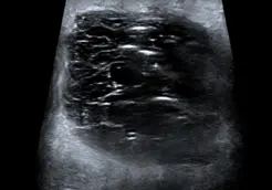 Mastitis