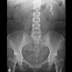 Nephrolithiasis