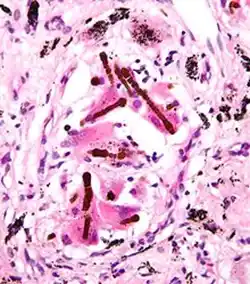Pneumoconioses