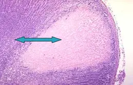 Renal Infarction