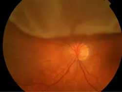 Retinal Detachment