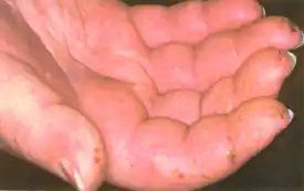 Scleroderma