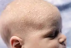 Seborrheic Dermatitis