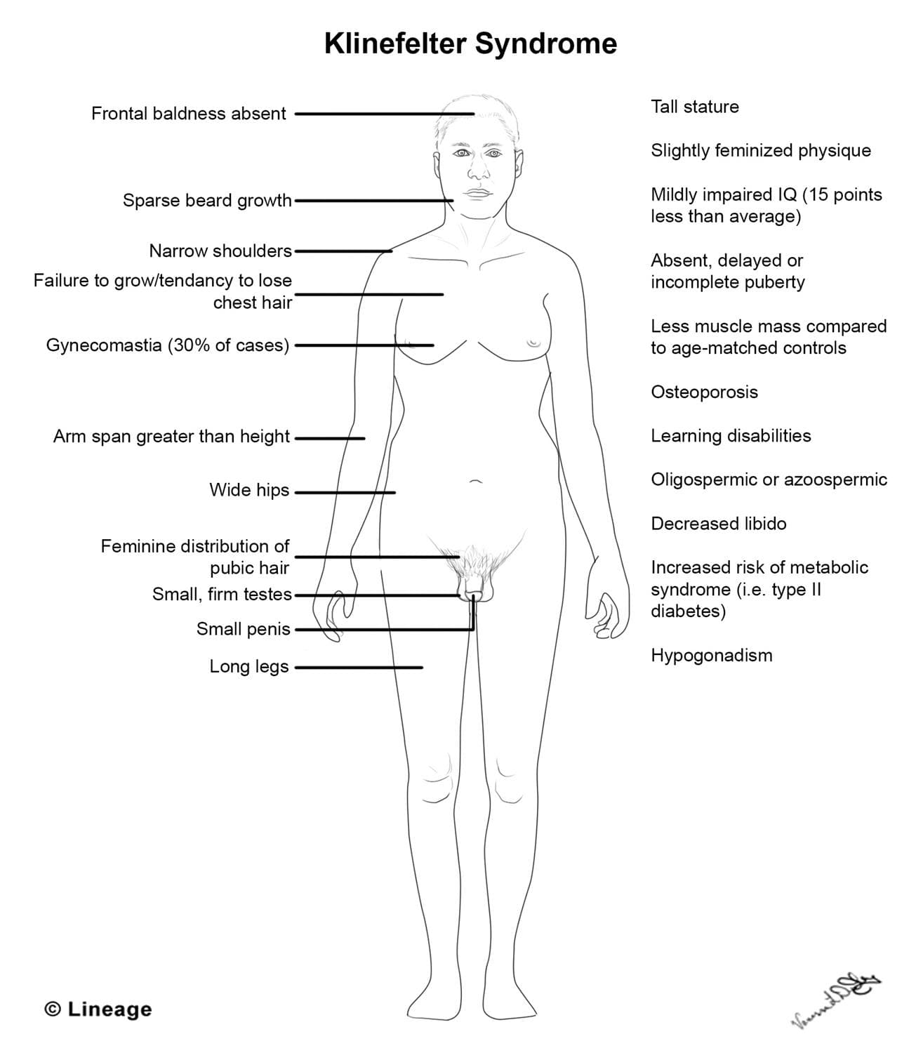 Klinefelter Syndrome USMLE Strike