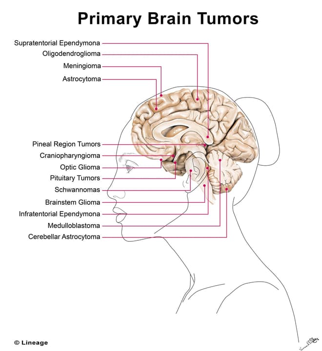 Primary Brain Tumors - USMLE Strike