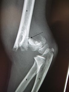 Supracondylar Humerus Fracture - USMLE Strike